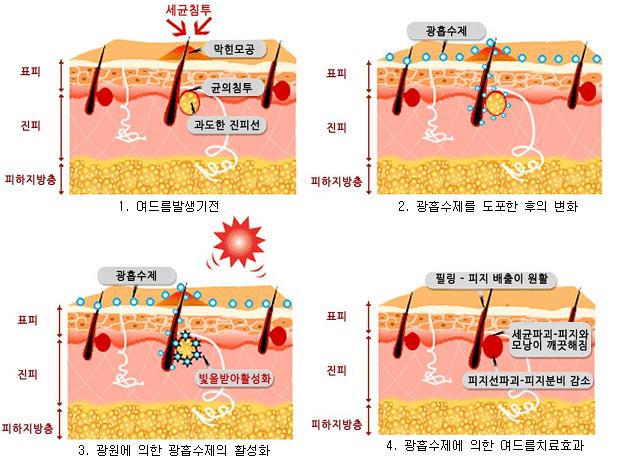 펄피부과 칼럼 - 여드름치료, 여드름 재발을 줄이는 PDT 치료법